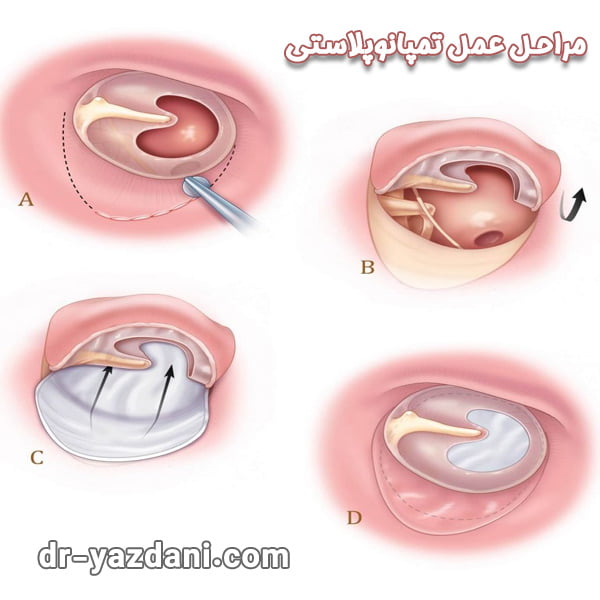 تمپانوپلاستی - دکتر جواد یزدانی