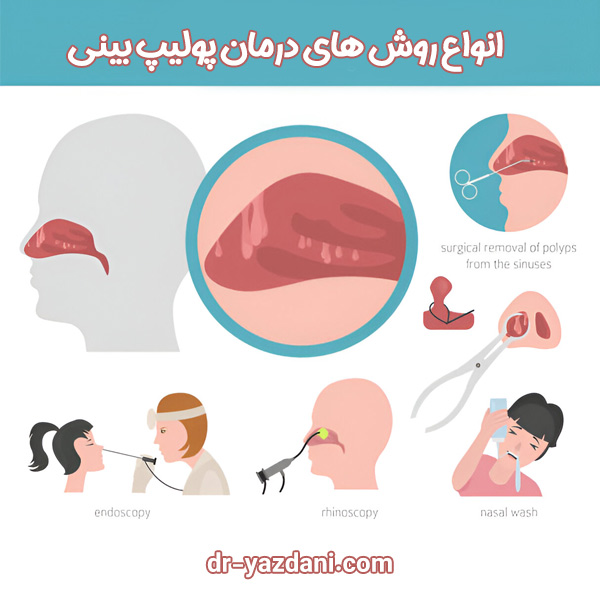 درمان پولیپ بینی - دکتر جواد یزدانی 