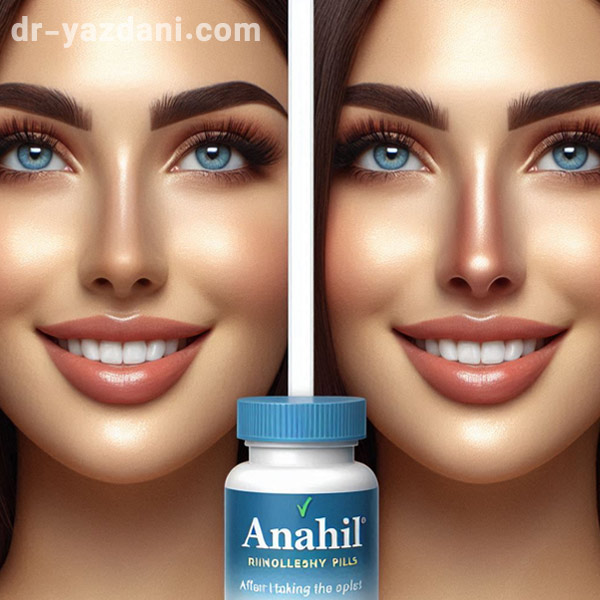 اناهیل بعد از عمل بینی - دکتر جواد یزدانی