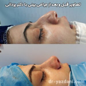 نمونه کار بهترین جراح بینی تهران - دکتر جواد یزدانی