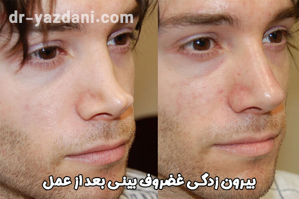بیرون زدگی غضروف بینی بعد از عمل - دکتر جواد یزدانی