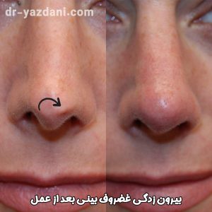 بیرون زدگی غضروف بینی بعد از عمل - دکتر جواد یزدانی
