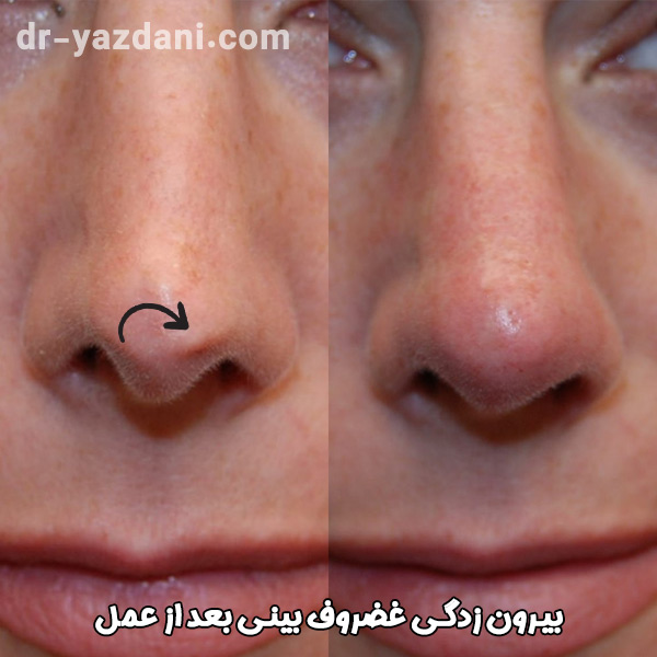 بیرون زدگی غضروف بینی بعد از عمل - دکتر جواد یزدانی