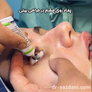 پماد روی چشم در جراحی بینی - دکتر جواد یزدانی