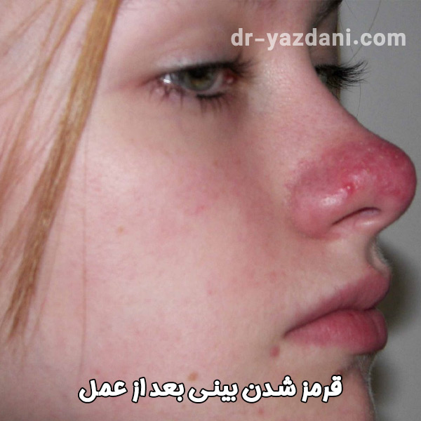 قرمز شدن پوست بینی بعد از عمل - دکتر جواد یزدانی