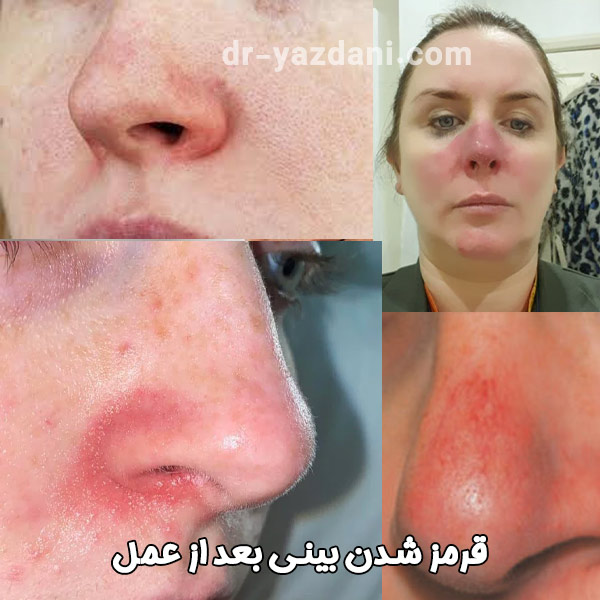 قرمزی بینی بعد از عمل - دکتر جواد یزدانی