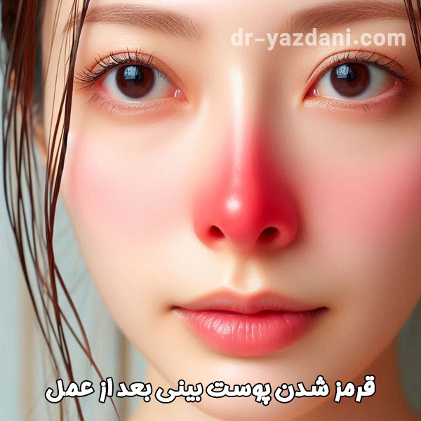 قرمزی بینی بعد از عمل - دکتر جواد یزدانی