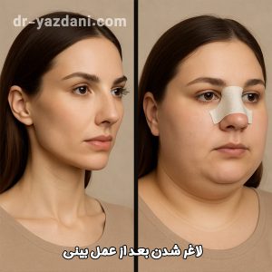 لاغر شدن بعد از عمل بینی | دکتر جواد یزدانی
