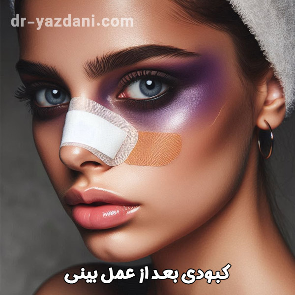 کبودی بعد از عمل بینی | دکتر جواد یزدانی 