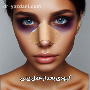 کبودی بعد از عمل بینی | دکتر جواد یزدانی