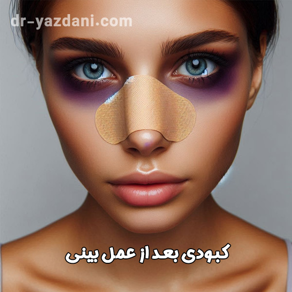کبودی بعد از عمل بینی | دکتر جواد یزدانی 