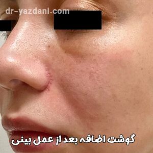گوشت اضافه بعد از عمل بینی - دکتر جواد یزدانی