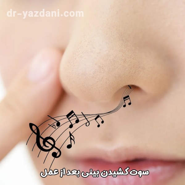 سوت کشیدن بینی بعد از عمل - دکتر جواد یزدانی 