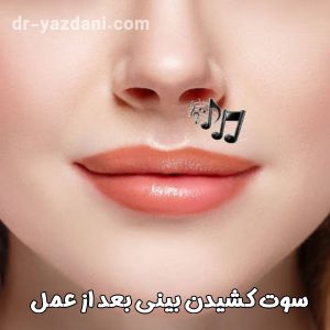 سوت کشیدن بینی بعد از عمل - دکتر جواد یزدانی