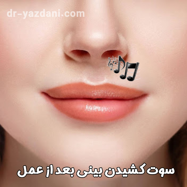 سوت کشیدن بینی بعد از عمل - دکتر جواد یزدانی 