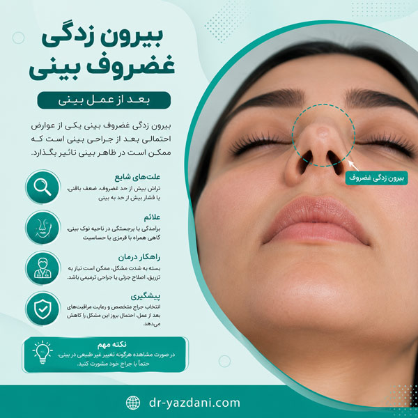  بیرون زدگی غضروف بینی - دکتر یزدانی