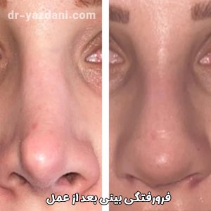 فرورفتگی بینی بعد از عمل - دکتر جواد یزدانی