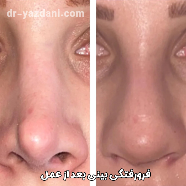 فرورفتگی بینی بعد از عمل - دکتر جواد یزدانی