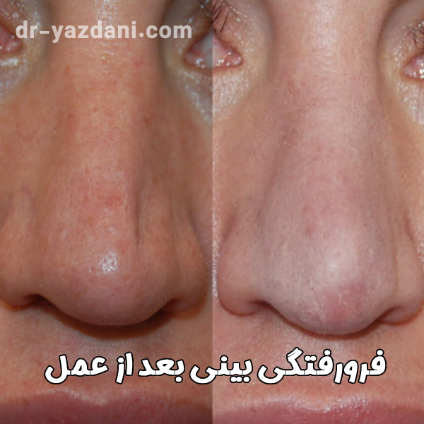 فرورفتگی بینی بعد از عمل - دکتر جواد یزدانی