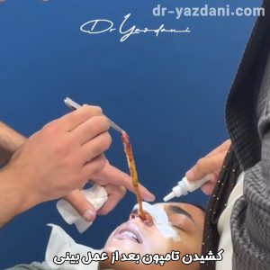 کشیدن تامپون بینی - دکتر جواد یزدانی