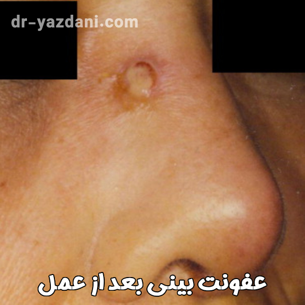 عفونت بینی بعد از عمل - دکتر جواد یزدانی