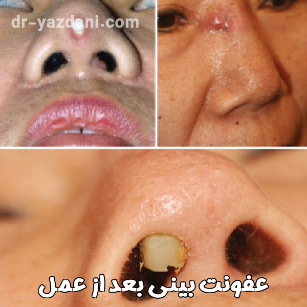 عفونت بینی بعد از عمل - دکتر جواد یزدانی