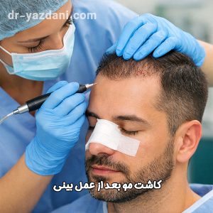 کاشت مو بعد از عمل بینی - دکتر جواد یزدانی