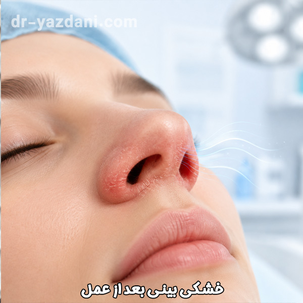 خشکی بینی بعد از عمل - دکتر جواد یزدانی
