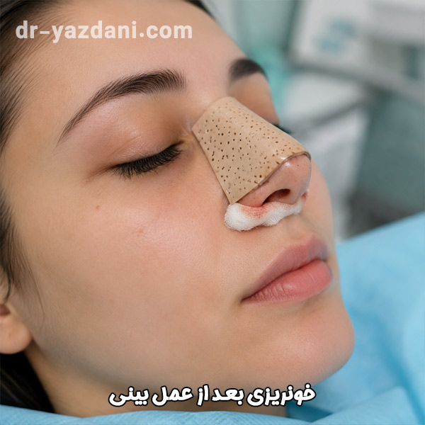 خونریزی بعد از عمل بینی - دکتر جواد یزدانی