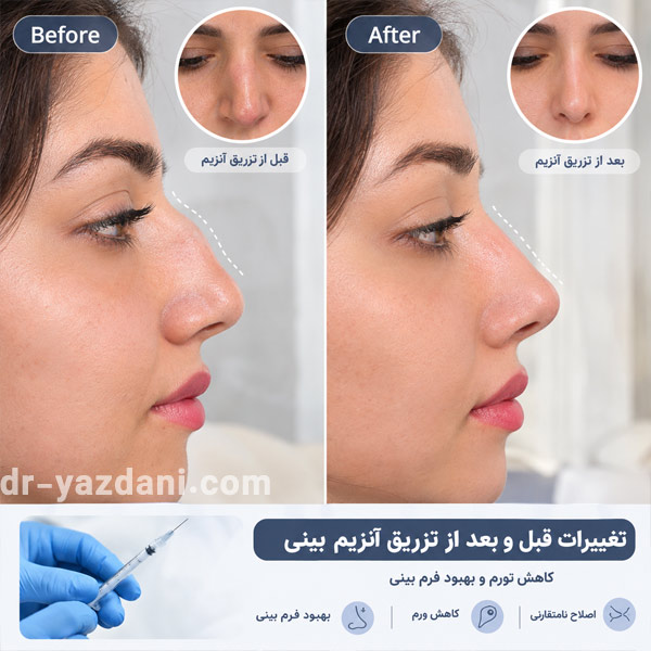 آنزیم بینی - دکتر جواد یزدانی