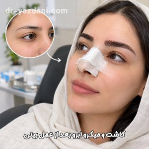 کاشت و میکرو ابرو بعد از عمل بینی - دکتر یزدانی